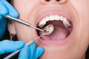 How Long Do Dental Bridges Last And What Makes Them Fail?